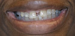 Before Anterior Crowns Closing Spaces