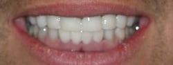 Tetracycline Bleaching and Crowns (Temporaries), After Treatment