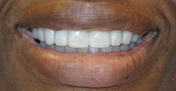 After Anterior Crowns Closing Spaces