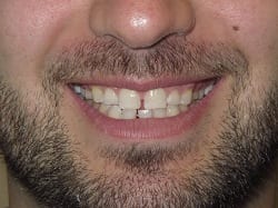 Before Full Mouth Reconstruction with Crowns/Veneers and Opening Bite