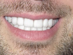 After Full Mouth Reconstruction with Crowns/Veneers and Opening Bite