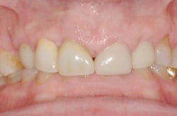 Full Mouth Reconstruction with Bite Opening on Severely Worn Teeth, Before
