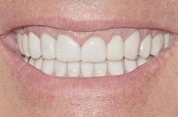 Full Mouth Reconstruction with Bite Opening on Severely Worn Teeth, After