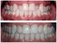 Crossbite before and after Invisalign treatment in Arden Arcade Sacramento CA