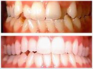 Teeth crowding before and after Invisalign treatment in Arden Arcade Sacramento CA