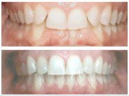 Overbite before and after Invisalign treatment in Arden Arcade Sacramento CA