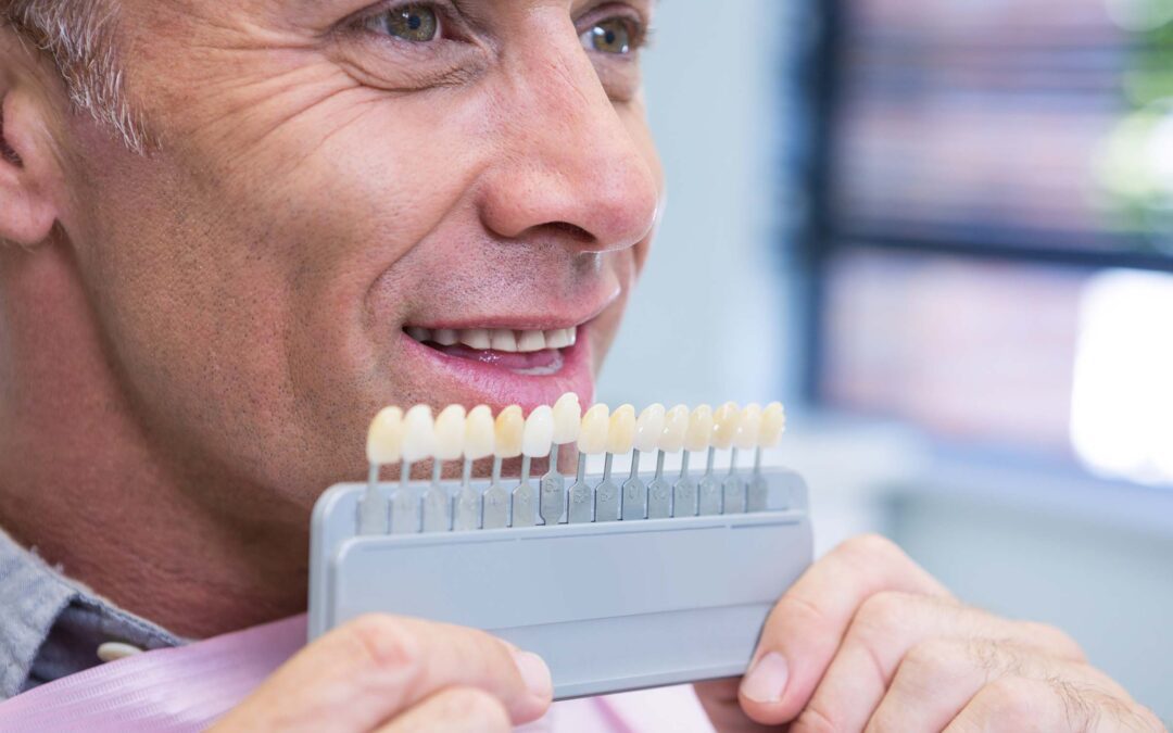 Can Veneers Damage Teeth?